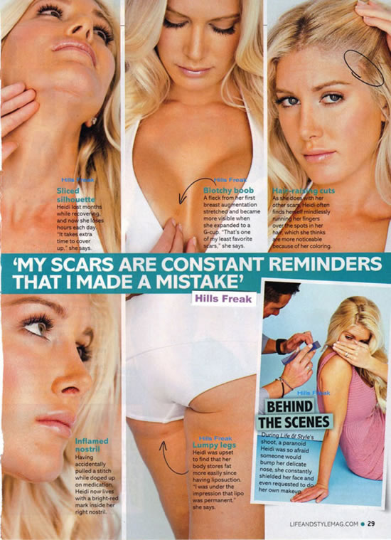 heidi montag surgery scars photos. Heidi Montag#39;s Regrettable
